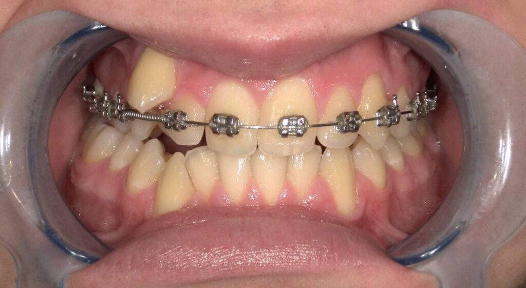 Braces before