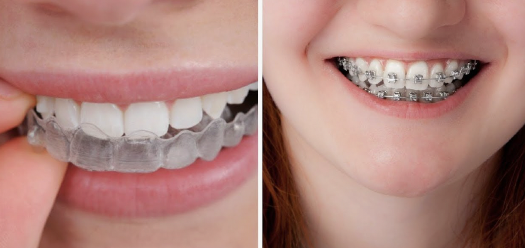 Invisalign vs. Braces in Encino