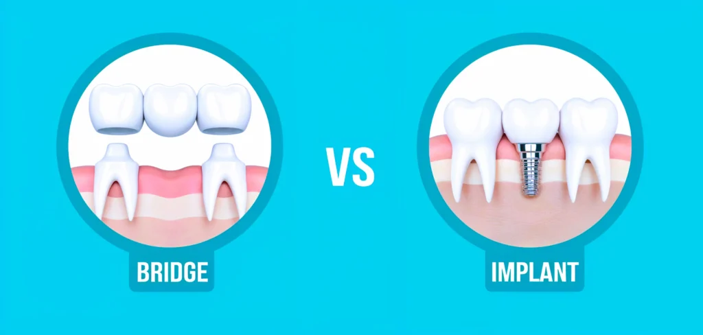 Dental Bridge vs Implant