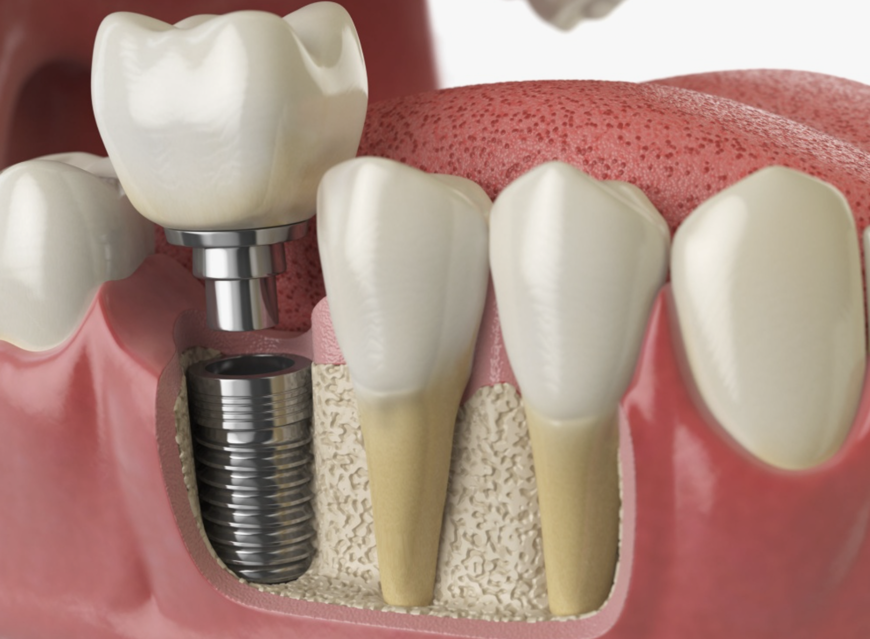 dental implants